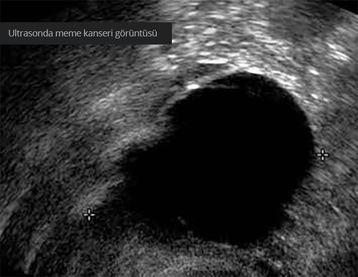 Meme kanseri ultrason görüntüsü