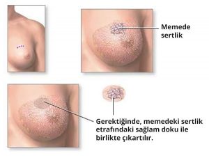 Memede sertlik