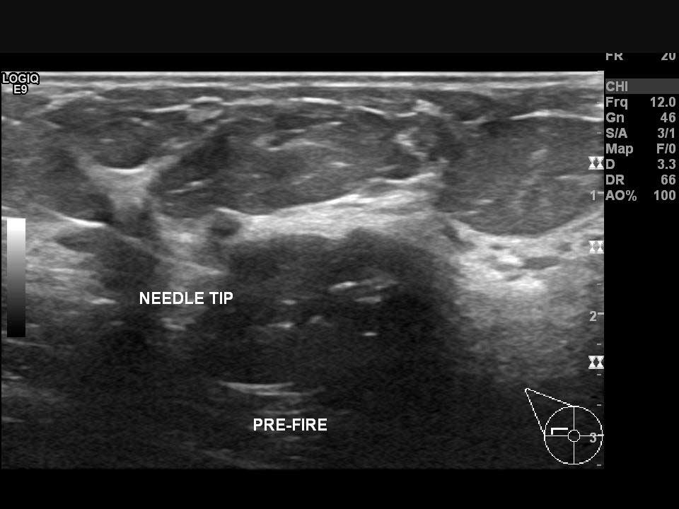 Sağ memedeki şüpheli bir odaktan ultrason kılavuzluğunda tru-cut biyopsi (kalın iğne biyopsisi) yapılması