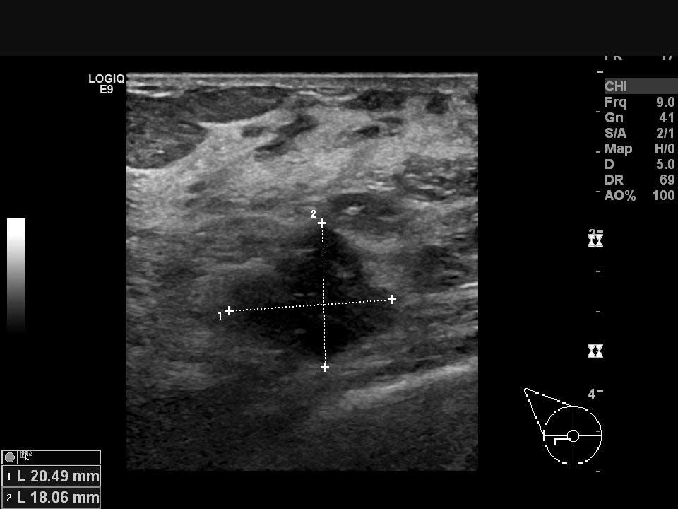 Ultrasonla görüntülenen sol meme kanseri odağı