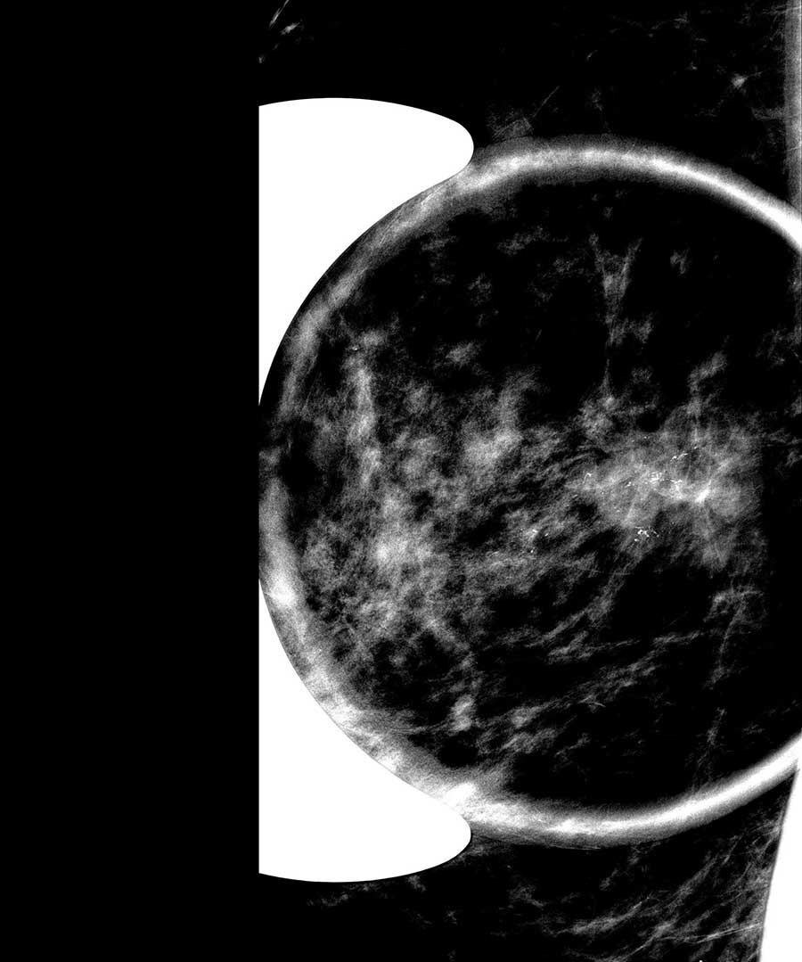 Memede şüpheli mikrokalsifikasyonların (kireçlenmeler) büyütme mamografisi ile incelenmesi