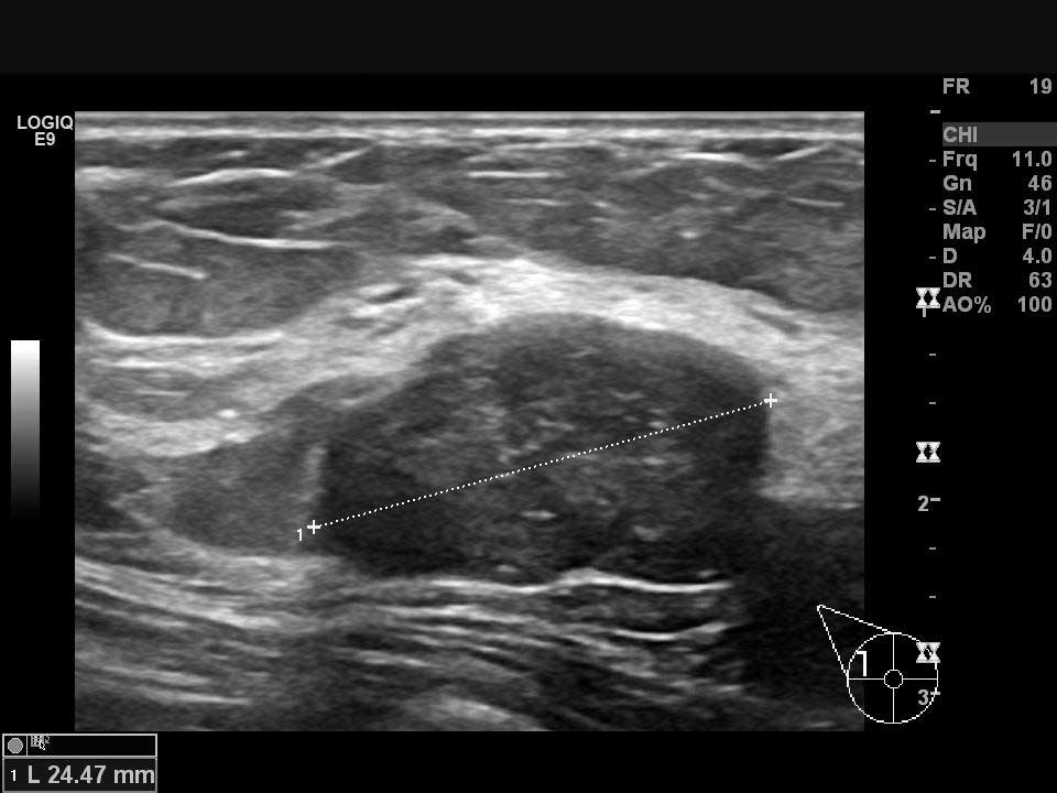 Memede ultrasonla görüntülenen fibroadenom