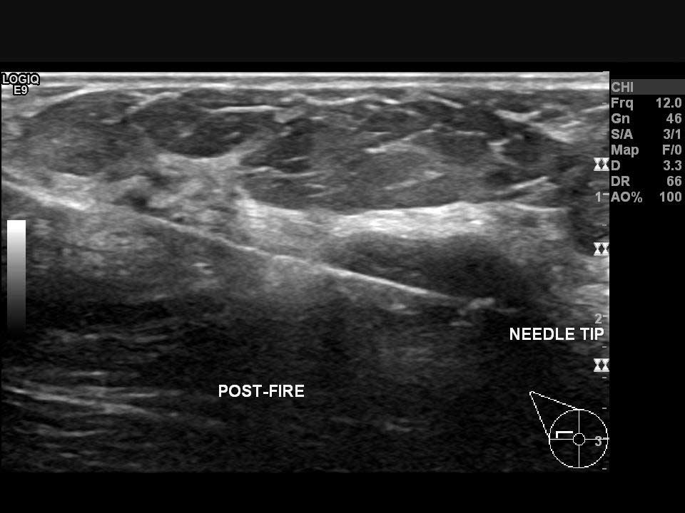 Sağ memedeki bir şüpheli odaktan ultrason kılavuzluğunda tru-cut biyopsi (kalın iğne biyopsisis) yapılması