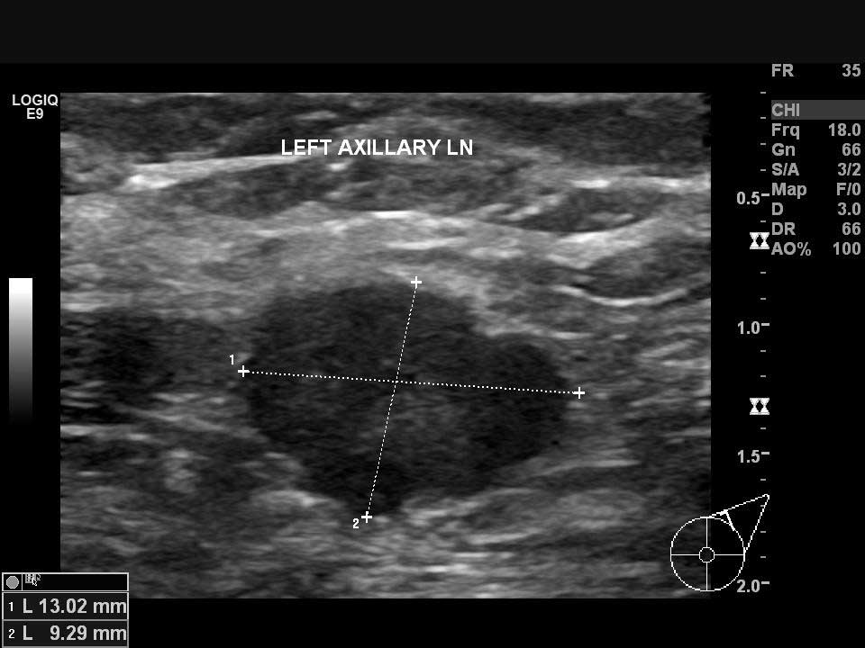 Sol koltuk altında ultrasonla saptanan kanserli lenf bezi
