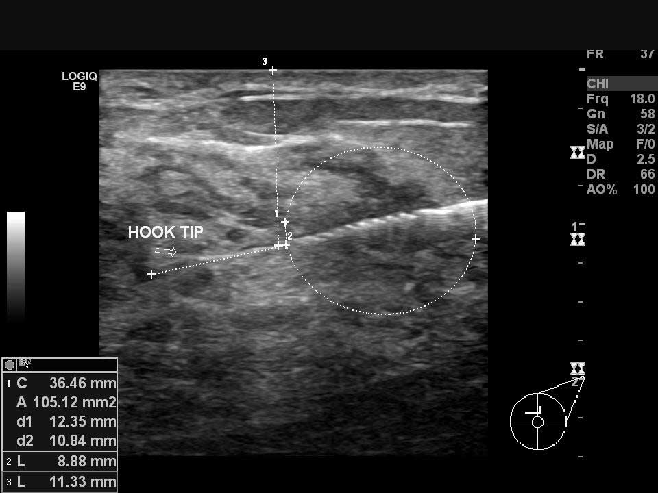 Sol memedeki kanser odağının ultrason kılavuzluğunda hook (çengel) ile işaretlenmesi