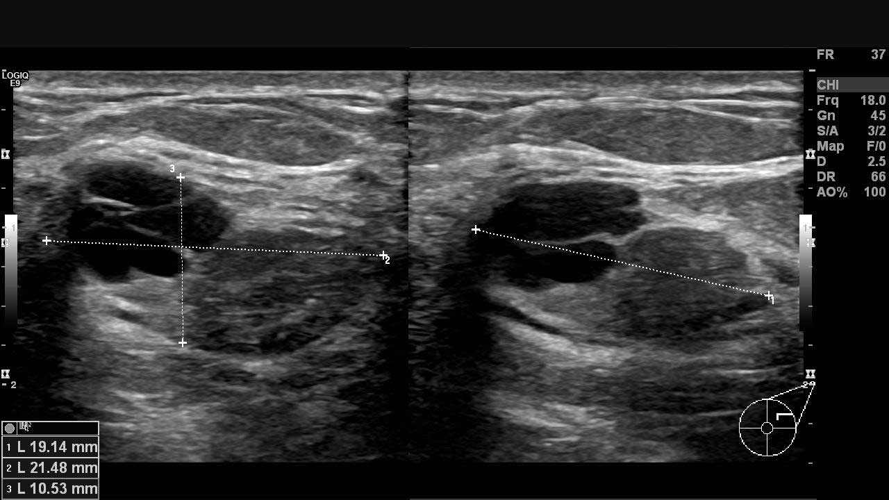 Sol memede ultrasonla gözlenen iyi huylu olabilecek yapılar