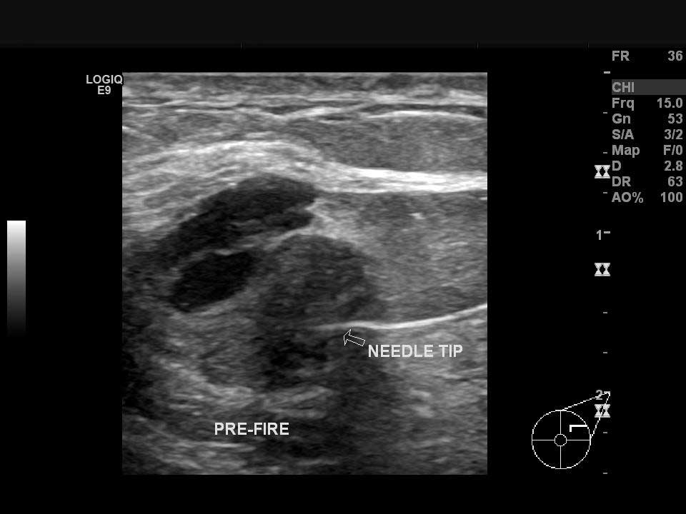 Sol memedeki odaktan ultrason kılavuzluğunda tru-cut biyopsi (kalın iğne biyopsisi) yapılması