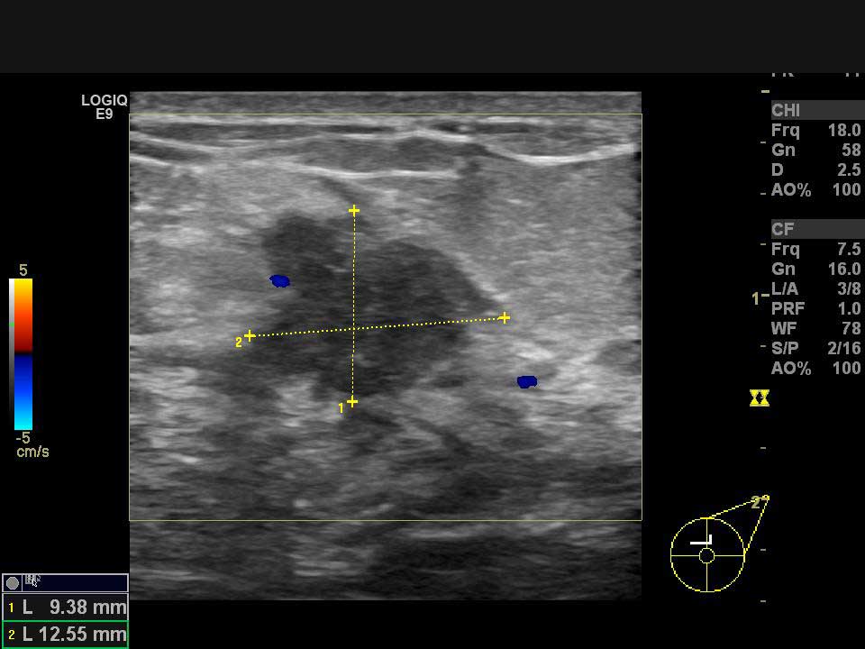 Ultrasonda izlenen meme kanseri odağı